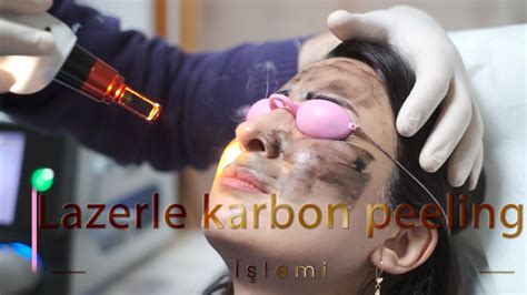 Lazerle Karbon Peeling Yaptıranlar: Deneyimler ve Yorumlar Lazerle Karbon Peeling Yaptıranlar: Deneyimler ve Yorumlar