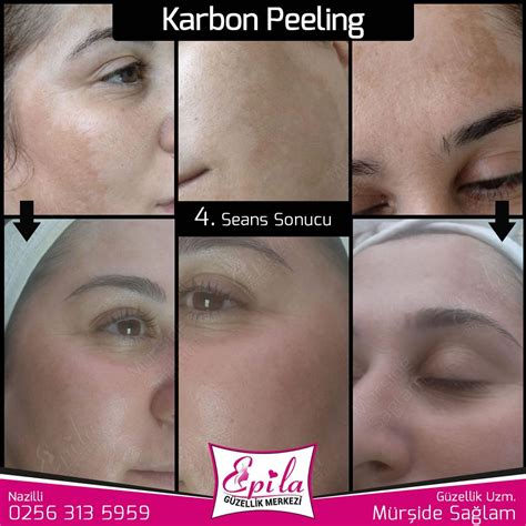 Karbon Peeling: Uygulama Karbon Peeling: Uygulama